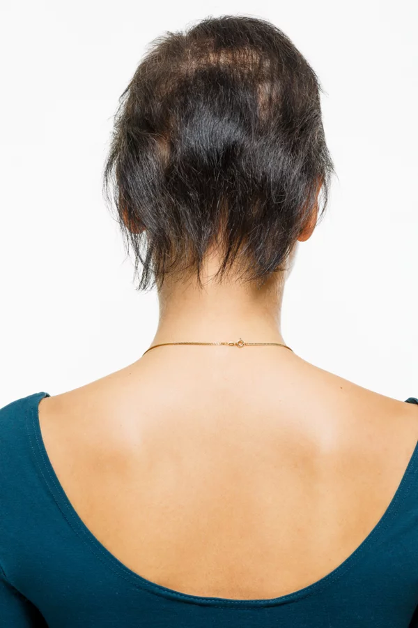 d&uuml;nnes Haar ohne Tritec-Hair<sup>&reg;</sup>